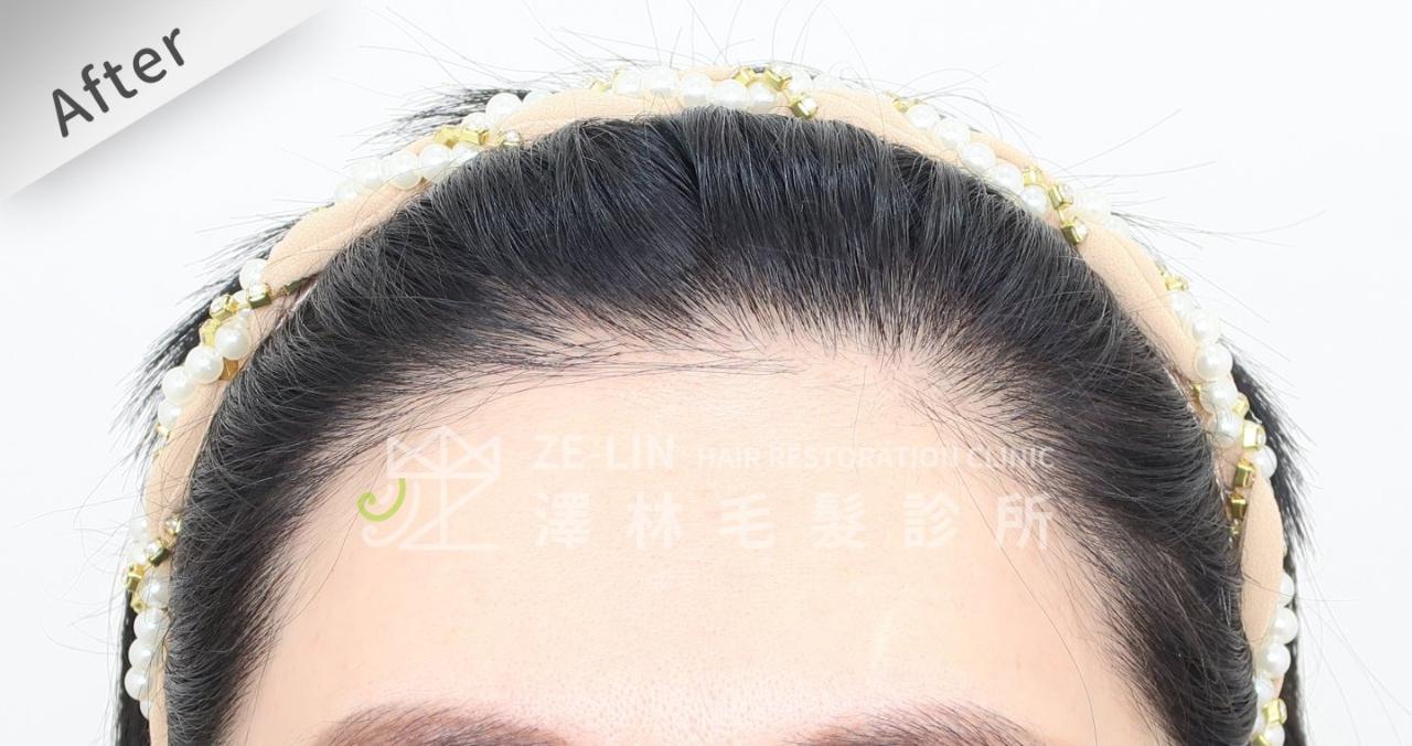 [女性植髮]女生高額頭額角禿頭髮際線免剃FUE植髮-美型髮際線植髮首選澤林毛髮診所謝宗廷醫師-術後3-1