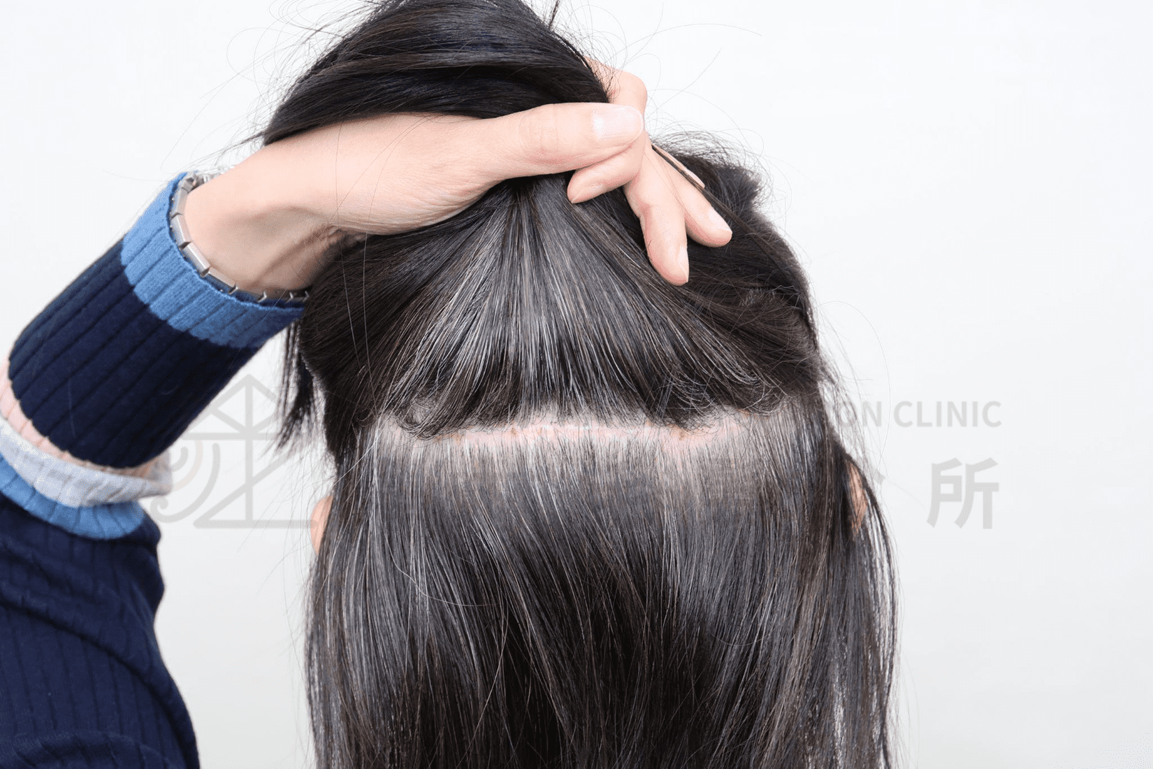 FUT植髮的疤痕正常髮型下可以完全遮蓋住
