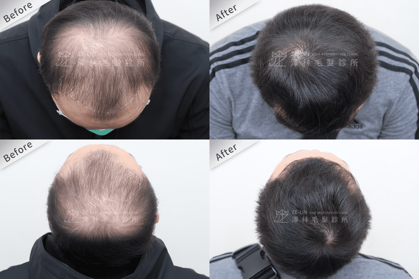 植髮案例1：大範圍落髮術前術後對照圖