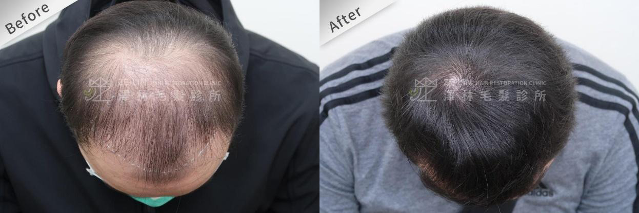 高額頭女孩髮際線設計