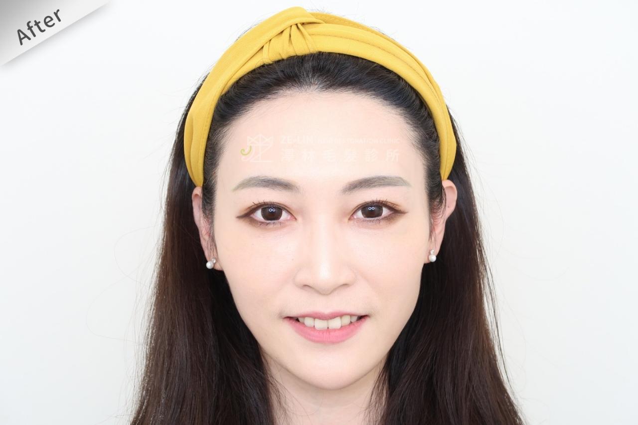 [女性植髮]女性高額頭植髮術後2-1