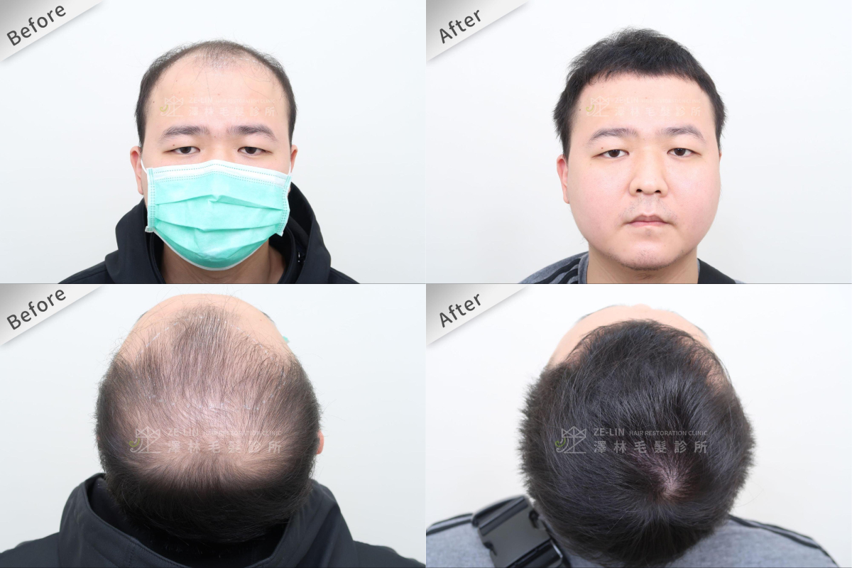 另一位髮友前額及頂部進行巨量植髮手術後的改變