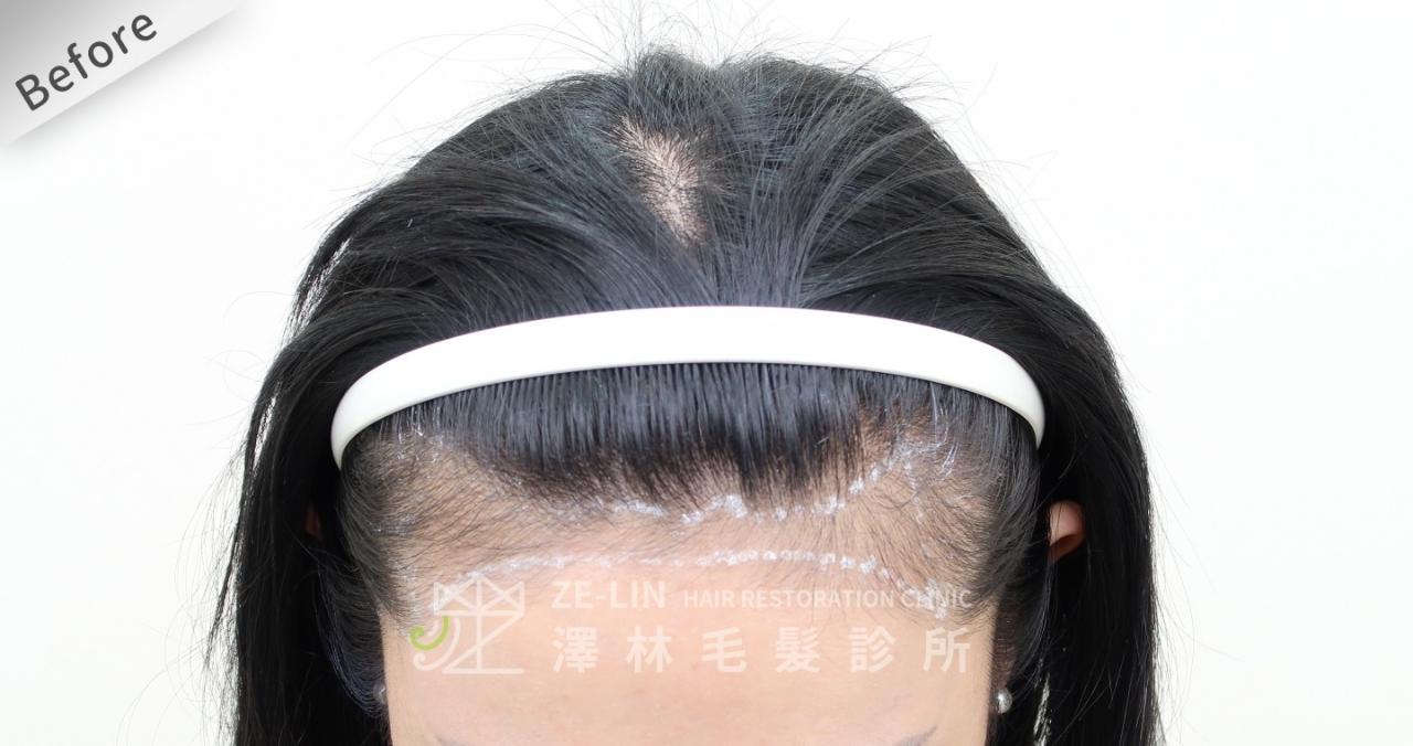 [女性植髮]女生高額頭額角禿頭髮際線免剃FUE植髮-美型髮際線植髮首選澤林毛髮診所謝宗廷醫師-術前3-2
