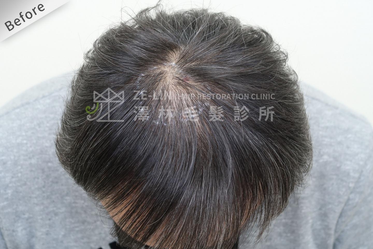 髮旋禿頭FUE高密度植髮心得推薦-植髮專家澤林毛髮診所謝宗廷醫師-雄性禿治療(柔沛)-術前3-1