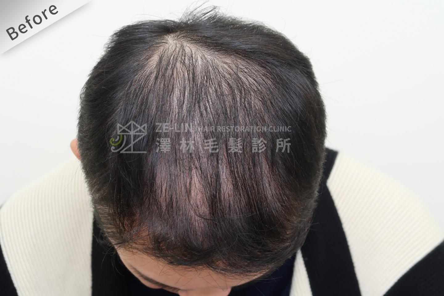頂部雄性禿巨量植髮FUE高密度植髮心得推薦-植髮專家澤林毛髮診所謝宗廷醫師-雄性禿治療(柔沛+落健生髮水) 術前