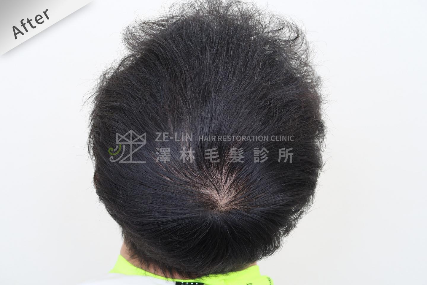 頂部雄性禿巨量植髮FUE高密度植髮心得推薦-植髮專家澤林毛髮診所謝宗廷醫師-雄性禿治療(柔沛+落健生髮水) 術後照