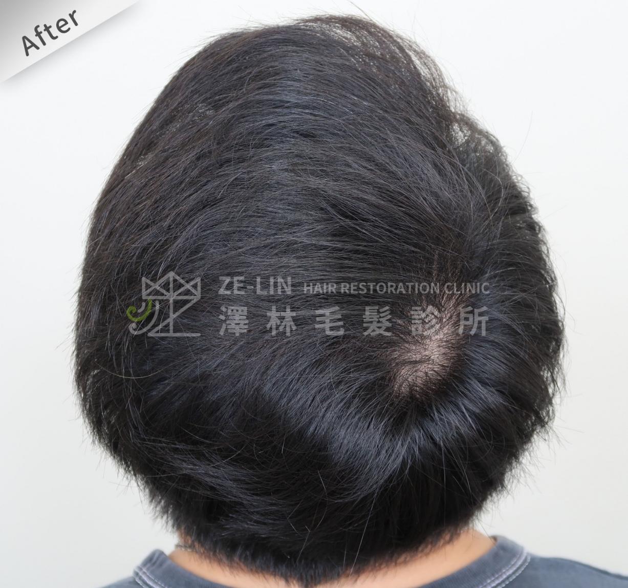 分髮線禿頭FUE高密度植髮心得推薦-植髮專家澤林毛髮診所謝宗廷醫師-雄性禿治療(柔沛)-術後4-2