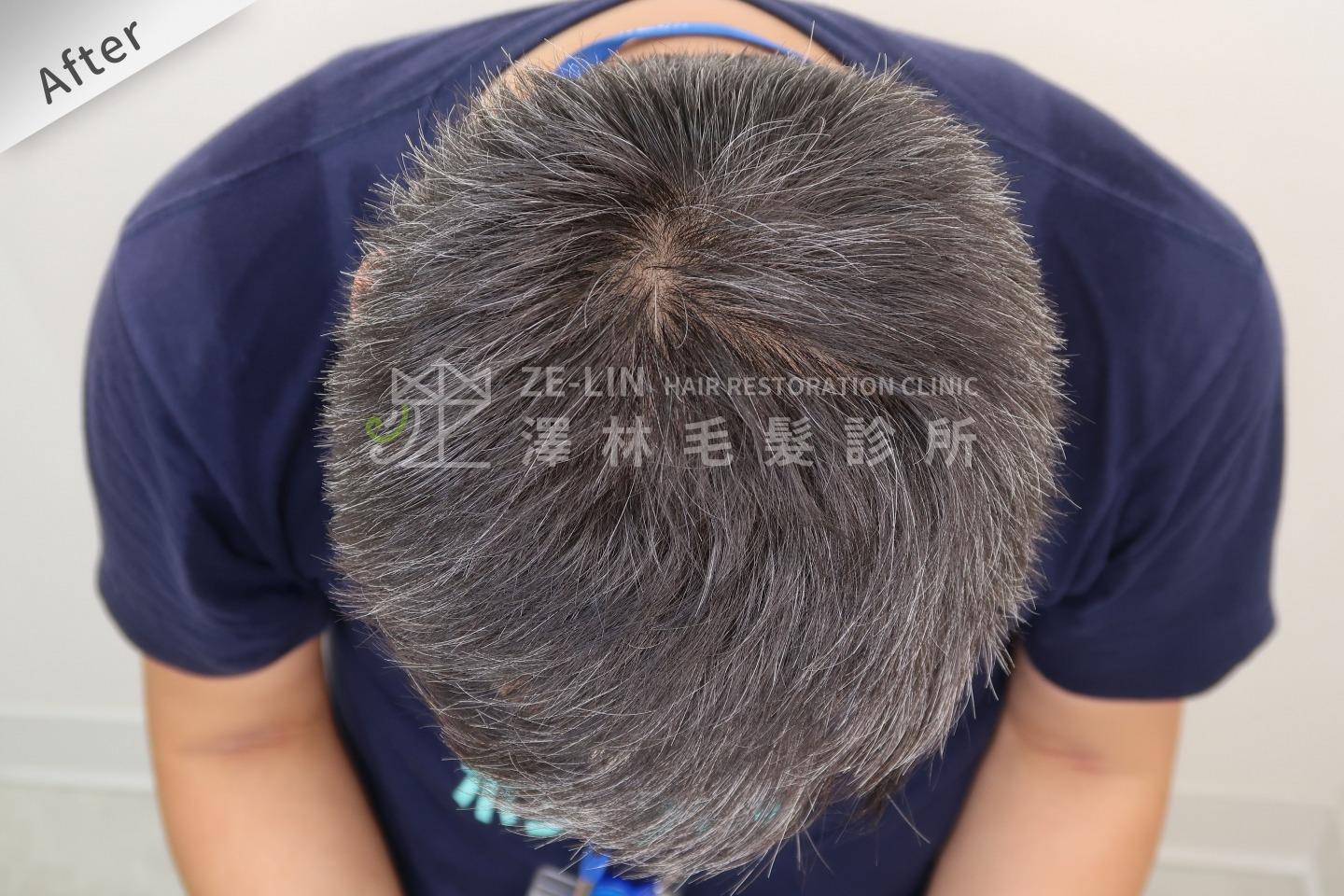 髮旋禿頭FUE高密度植髮心得推薦-植髮專家澤林毛髮診所謝宗廷醫師-雄性禿治療(柔沛)-術後3-1