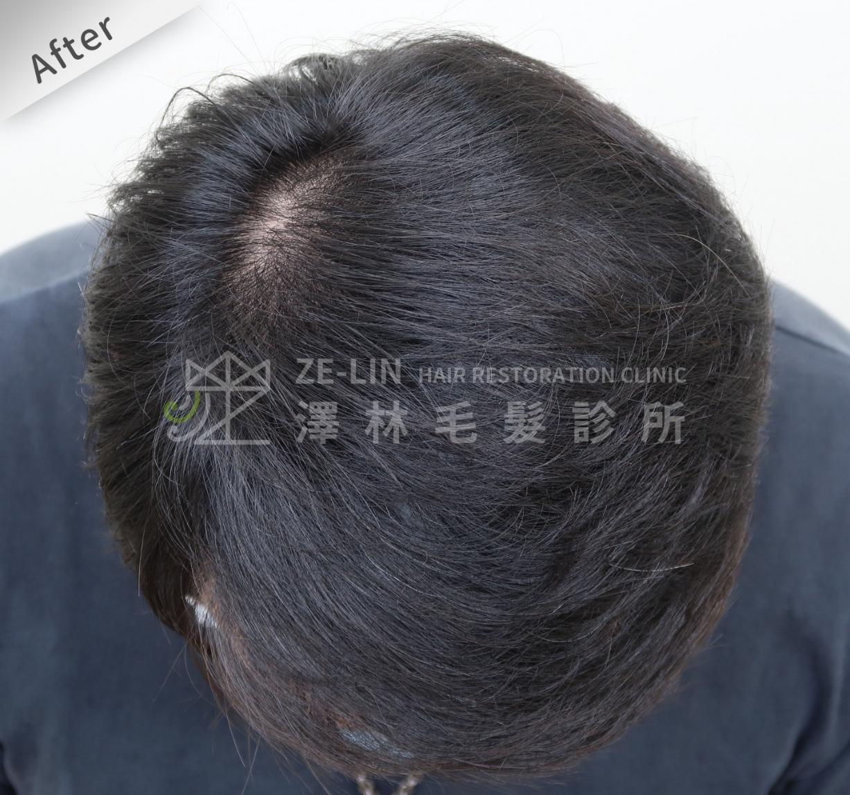 分髮線禿頭FUE高密度植髮心得推薦-植髮專家澤林毛髮診所謝宗廷醫師-雄性禿治療(柔沛)-術後4-1