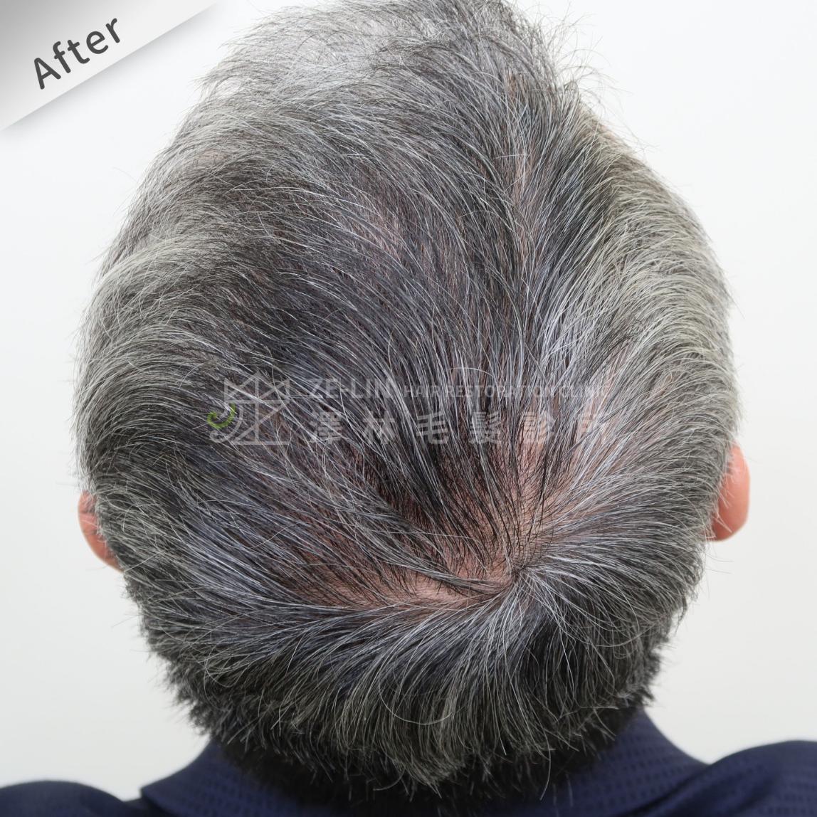 頂部地中海禿頭FUE高密度植髮心得推薦-植髮專家澤林毛髮診所謝宗廷醫師-雄性禿治療(柔沛)-術後3-1