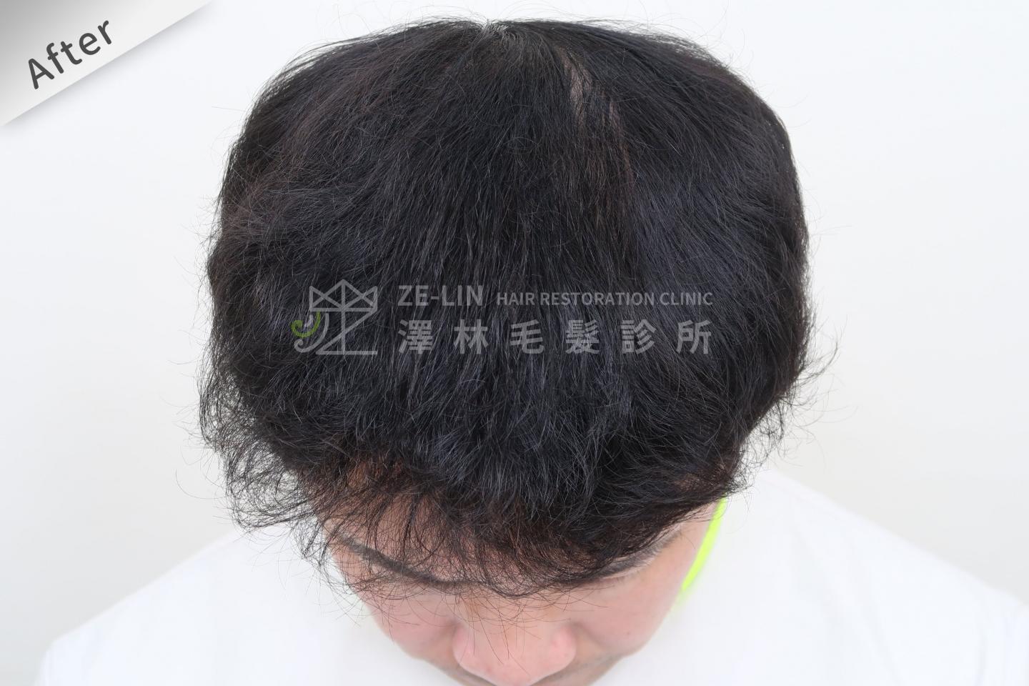 頂部雄性禿巨量植髮FUE高密度植髮心得推薦-植髮專家澤林毛髮診所謝宗廷醫師-雄性禿治療(柔沛+落健生髮水) 術後