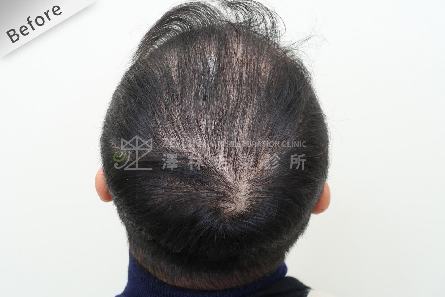 頂部雄性禿巨量植髮FUE高密度植髮心得推薦-植髮專家澤林毛髮診所謝宗廷醫師-雄性禿治療(柔沛+落健生髮水) 術前照