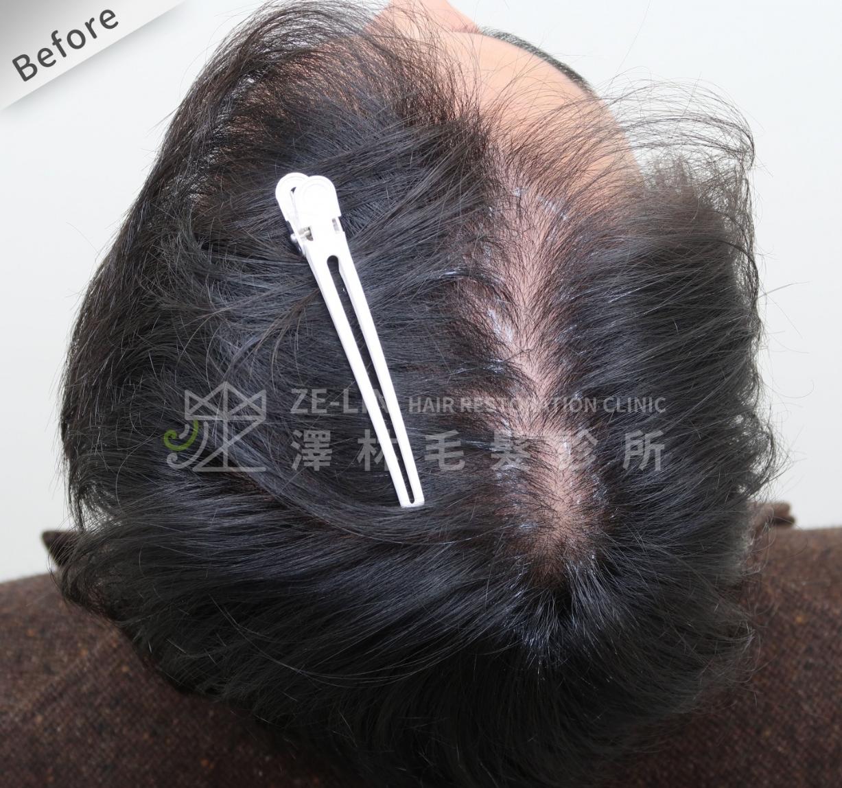 分髮線禿頭FUE高密度植髮心得推薦-植髮專家澤林毛髮診所謝宗廷醫師-雄性禿治療(柔沛)-術前4-2