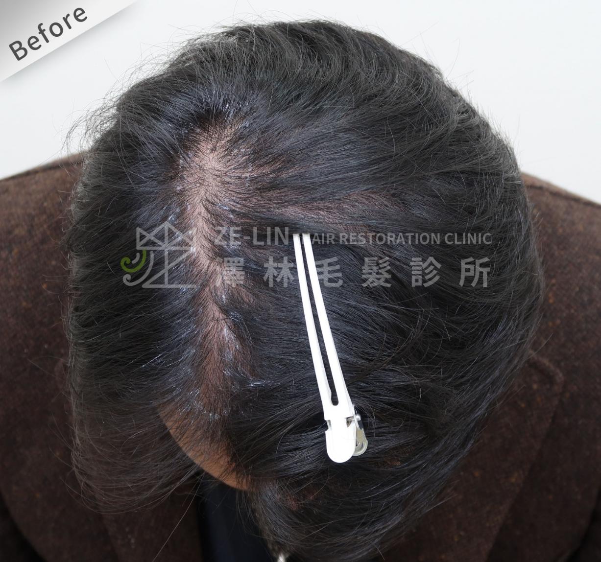 分髮線禿頭FUE高密度植髮心得推薦-植髮專家澤林毛髮診所謝宗廷醫師-雄性禿治療(柔沛)-術前4-1