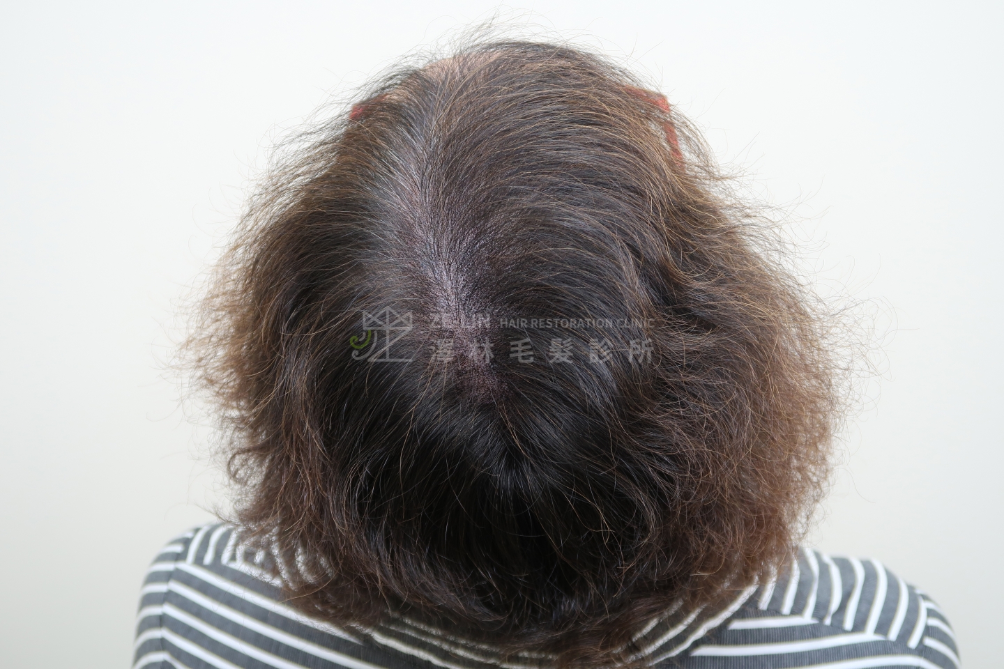 女生雄性禿使用SMP(Scalp Micro Pigmentation)擬真髮頭皮微點染色治療術後