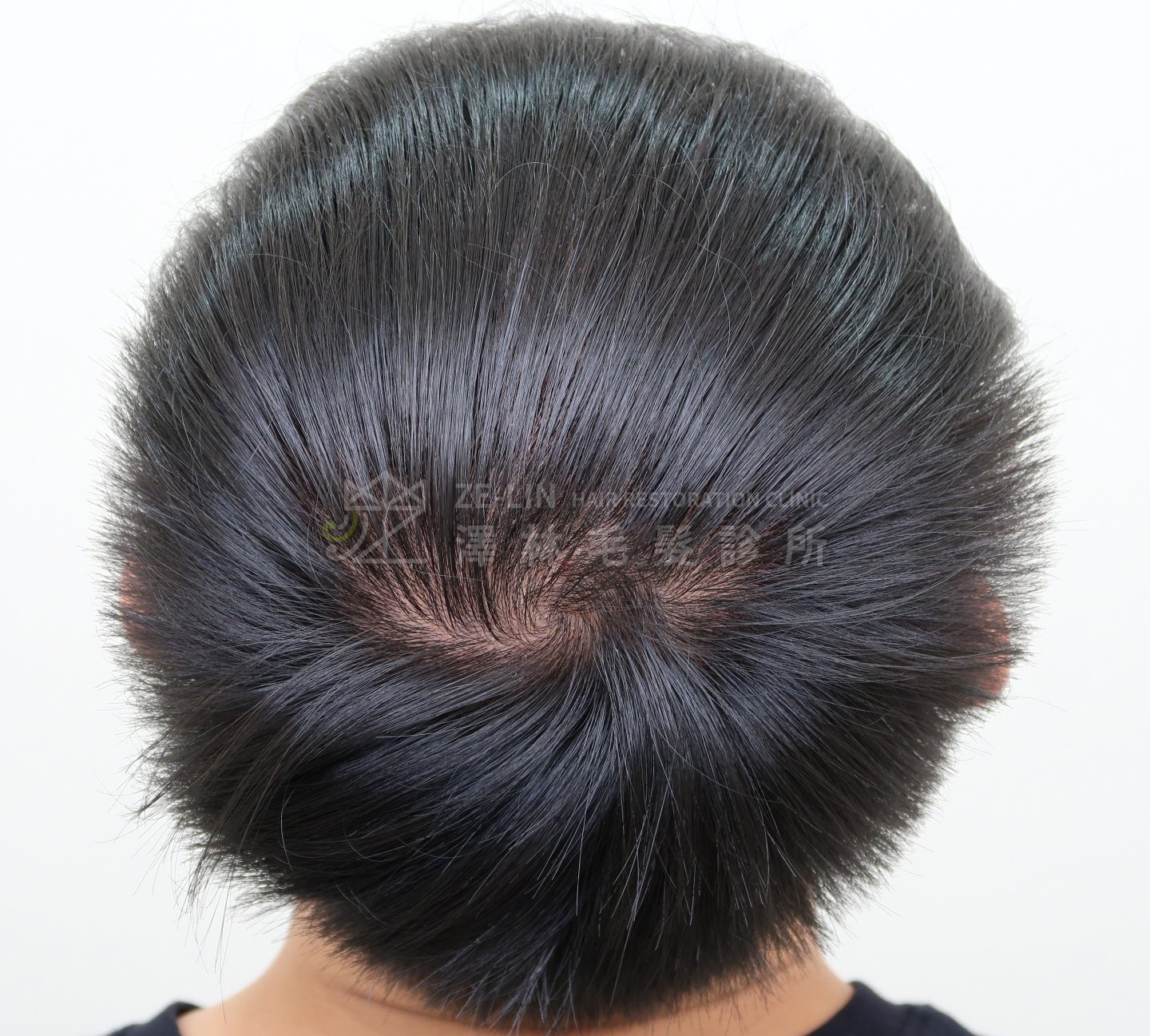 生髮育髮治療PRP自體生長因子注射治療雄性禿術前1