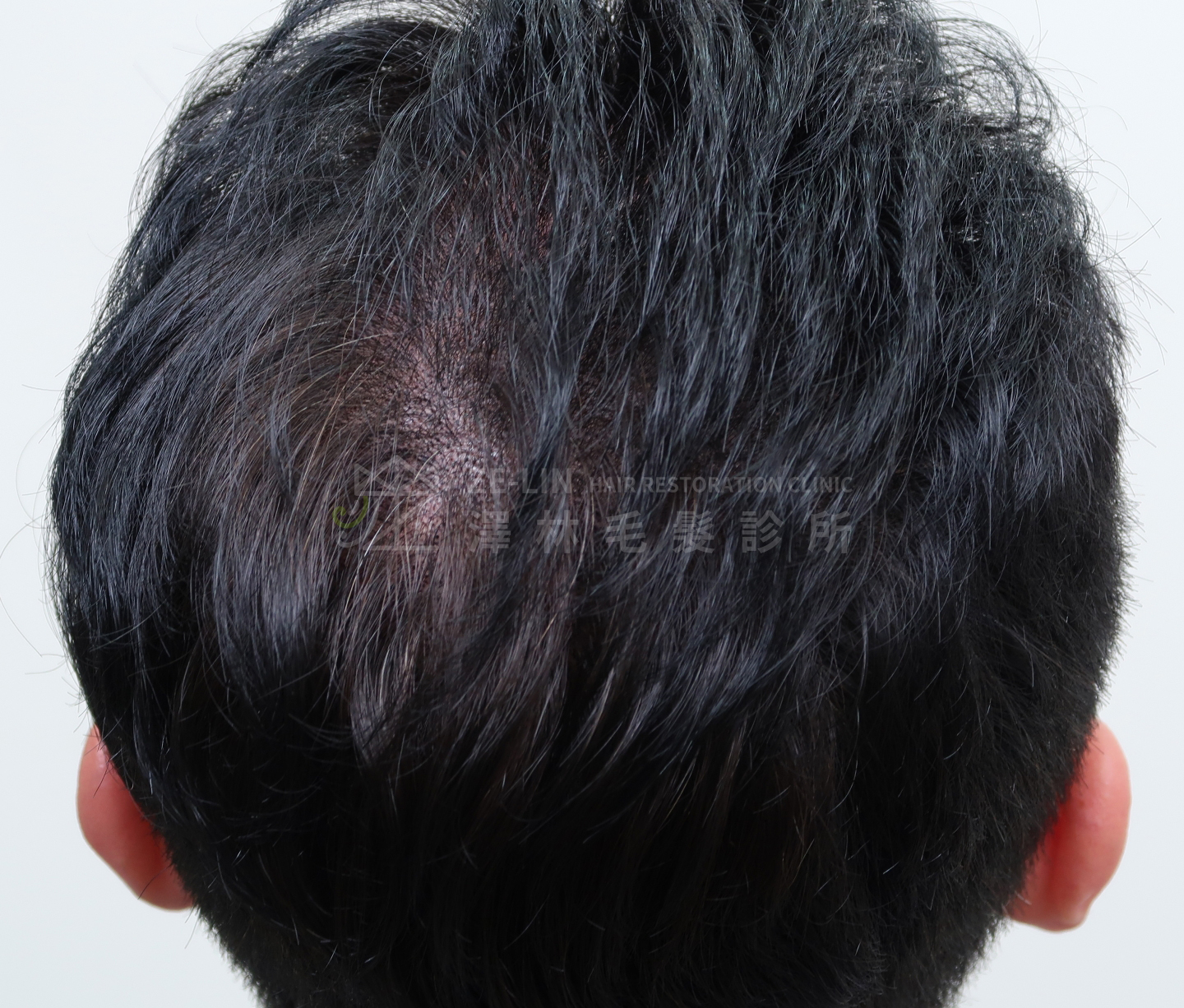 擬真髮頭皮微點染色(SMP)合併植髮手術治療案例術前