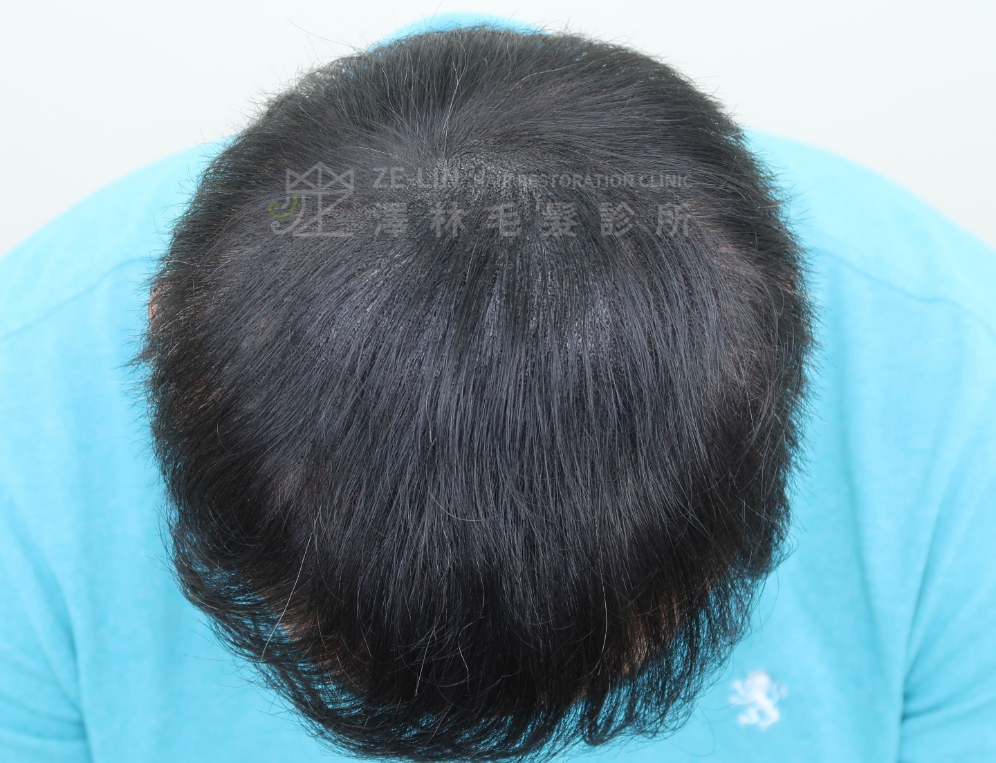 頂部及髮旋雄性禿使用SMP(Scalp Micro Pigmentation)擬真髮頭皮微點染色治療術後