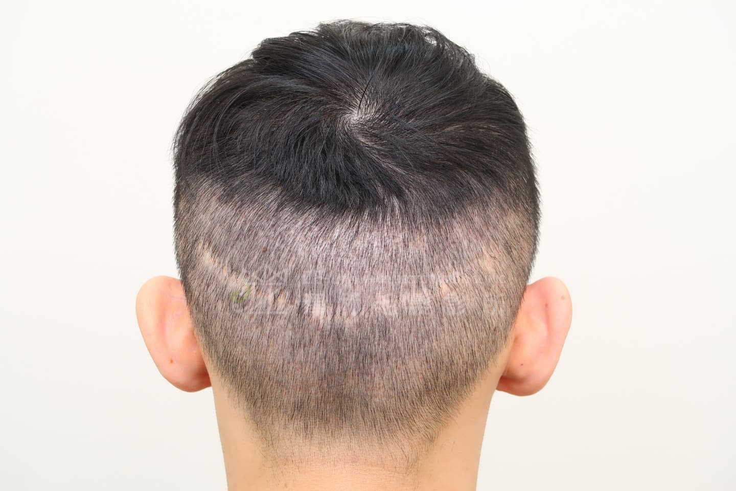 FUT植髮手術後的疤痕使用SMP(Scalp Micro Pigmentation)擬真髮頭皮微點染色治療案例術前