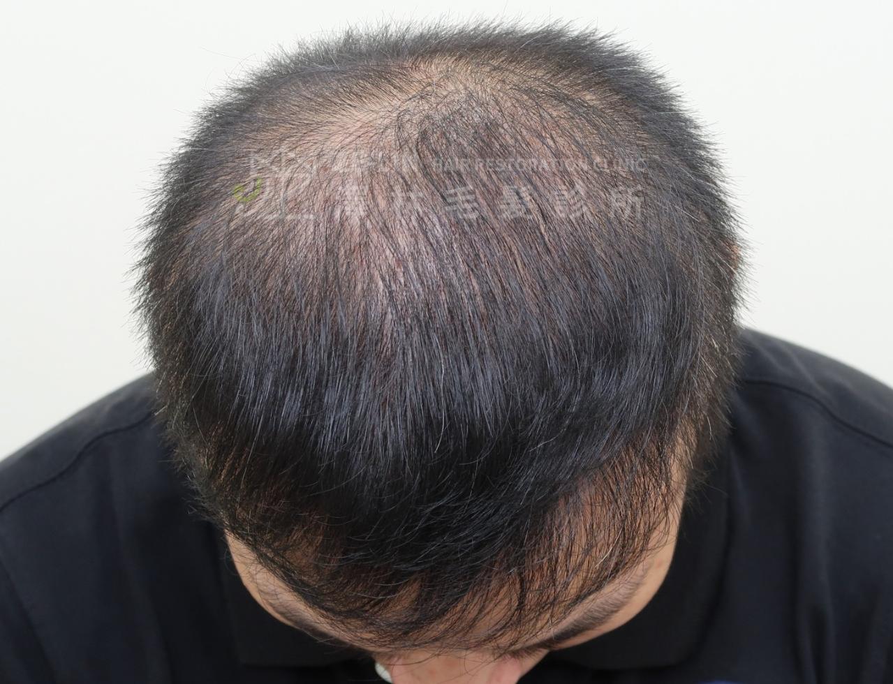 頂部及髮旋雄性禿使用SMP(Scalp Micro Pigmentation)擬真髮頭皮微點染色治療術前