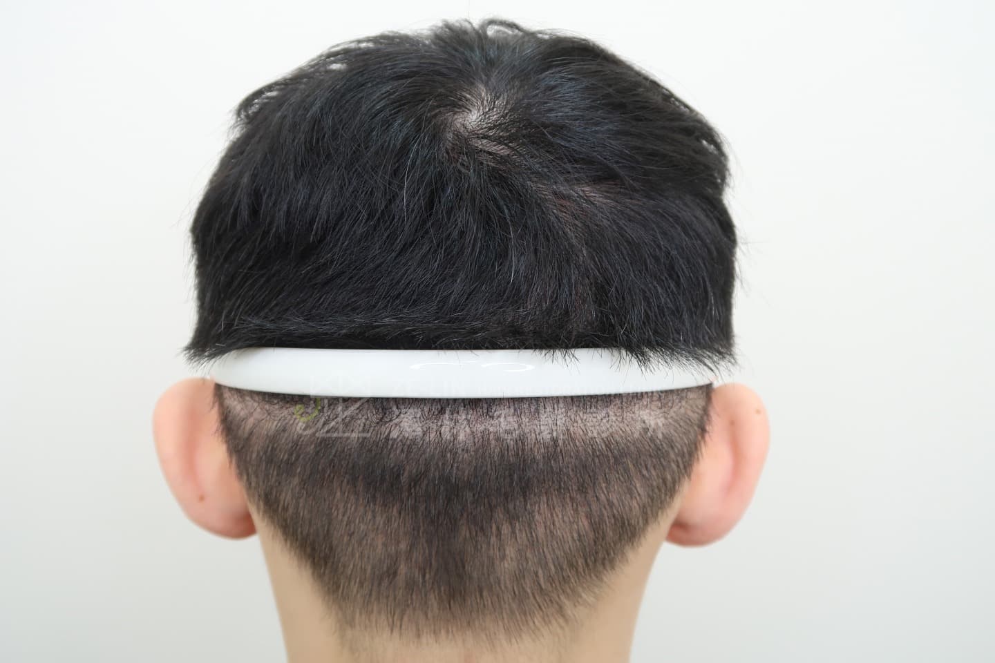 FUT植髮手術後的疤痕使用SMP(Scalp Micro Pigmentation)擬真髮頭皮微點染色治療案例術後