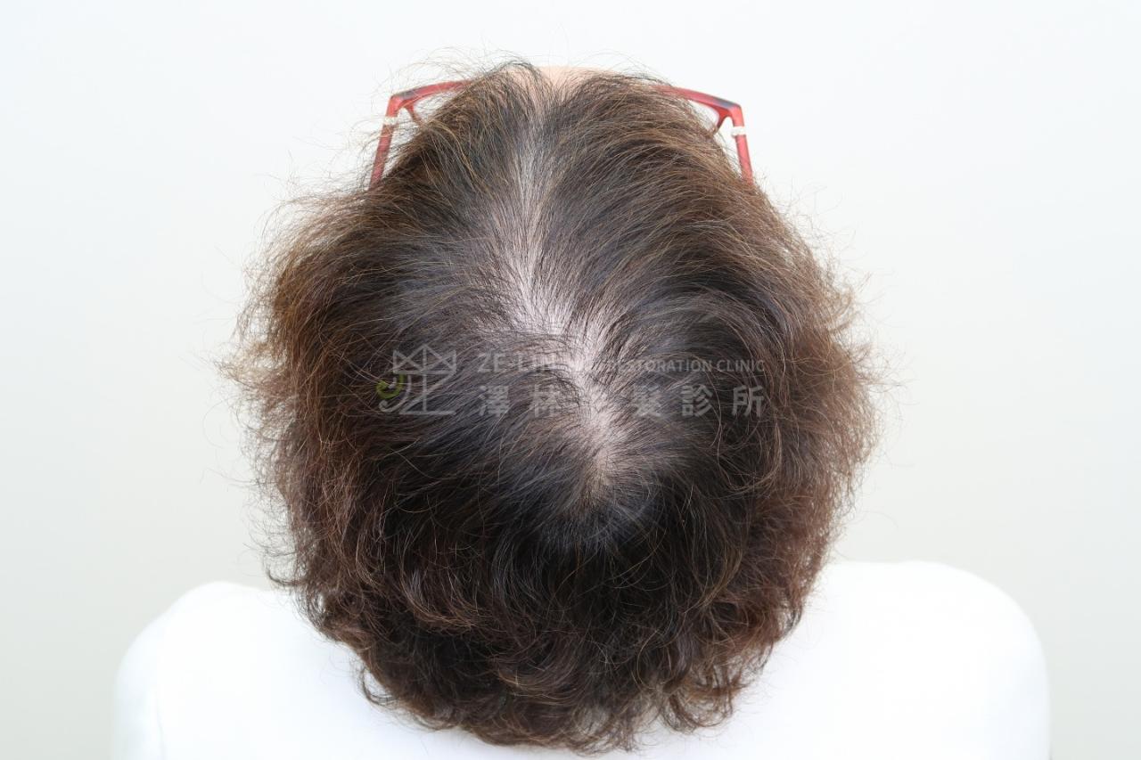 女生雄性禿使用SMP(Scalp Micro Pigmentation)擬真髮頭皮微點染色治療術前