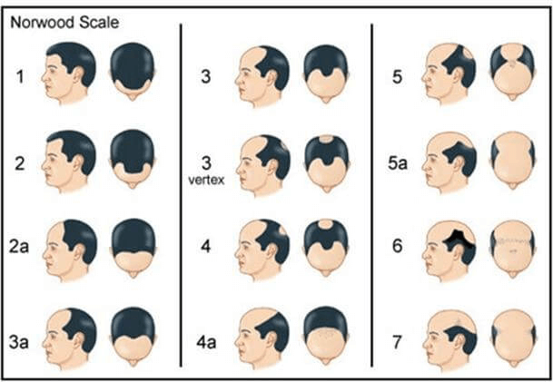 雄性禿若達第三期以上建議採取禿頭植髮手術