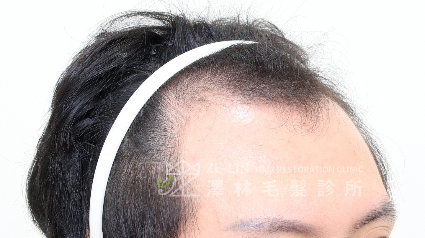 雄性禿m型禿植髮髮際線案例分享術前2 合併使用口服藥或生髮水保護