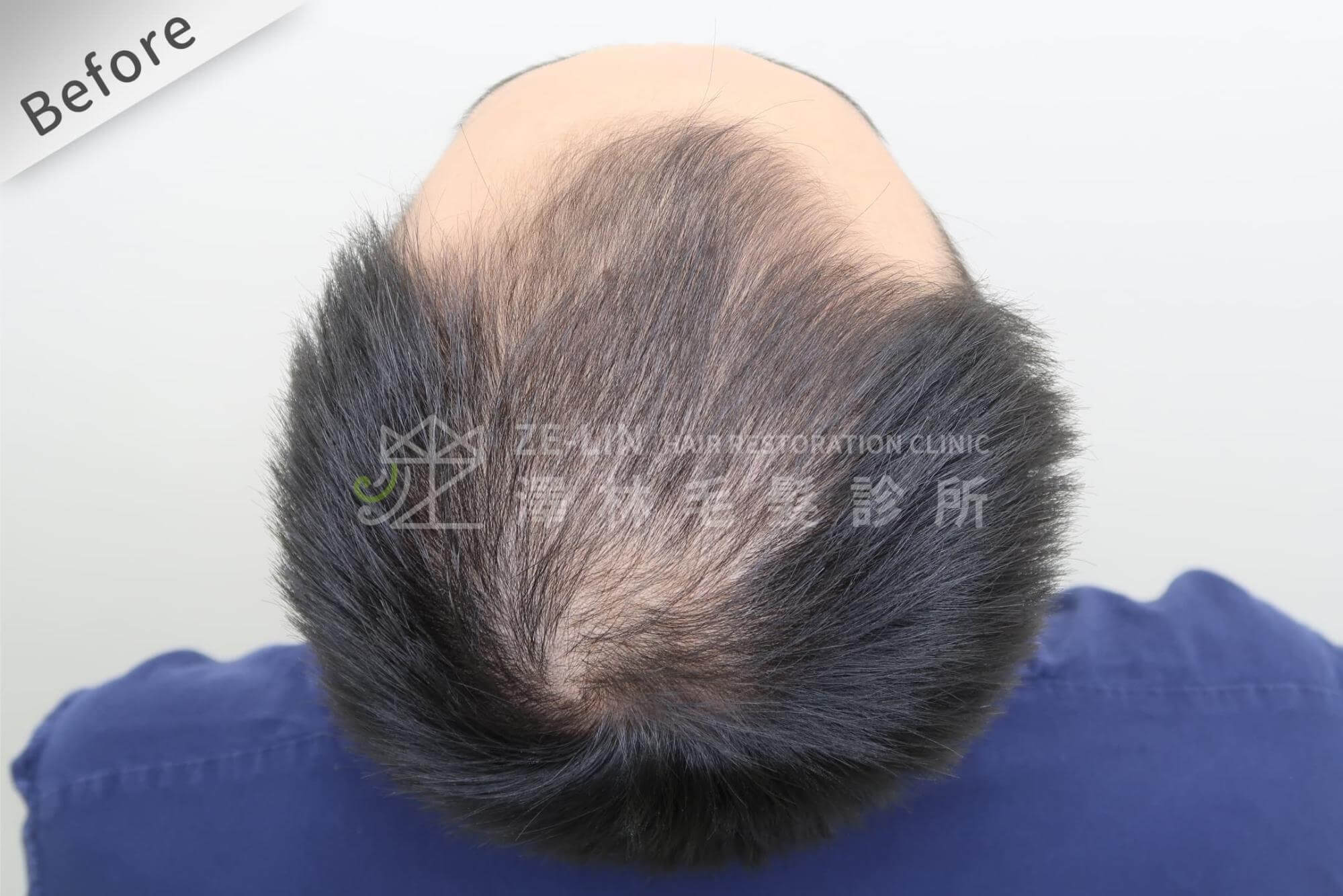 頭髮稀疏可透過禿頭植髮手術改善