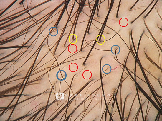 術前頭皮檢測採用毛囊檢測儀判斷細髮比例幫助醫師診斷