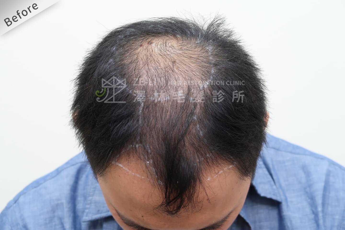 第五期雄性禿可採取禿頭植髮手術獲得改善