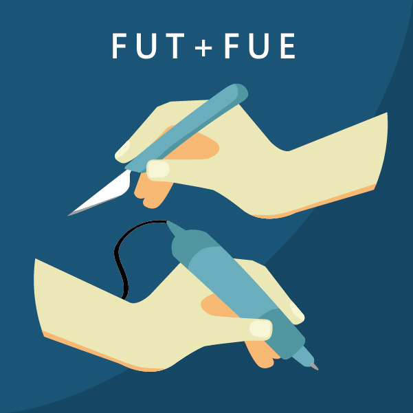 禿頭植髮手術類型：FUT+FUE