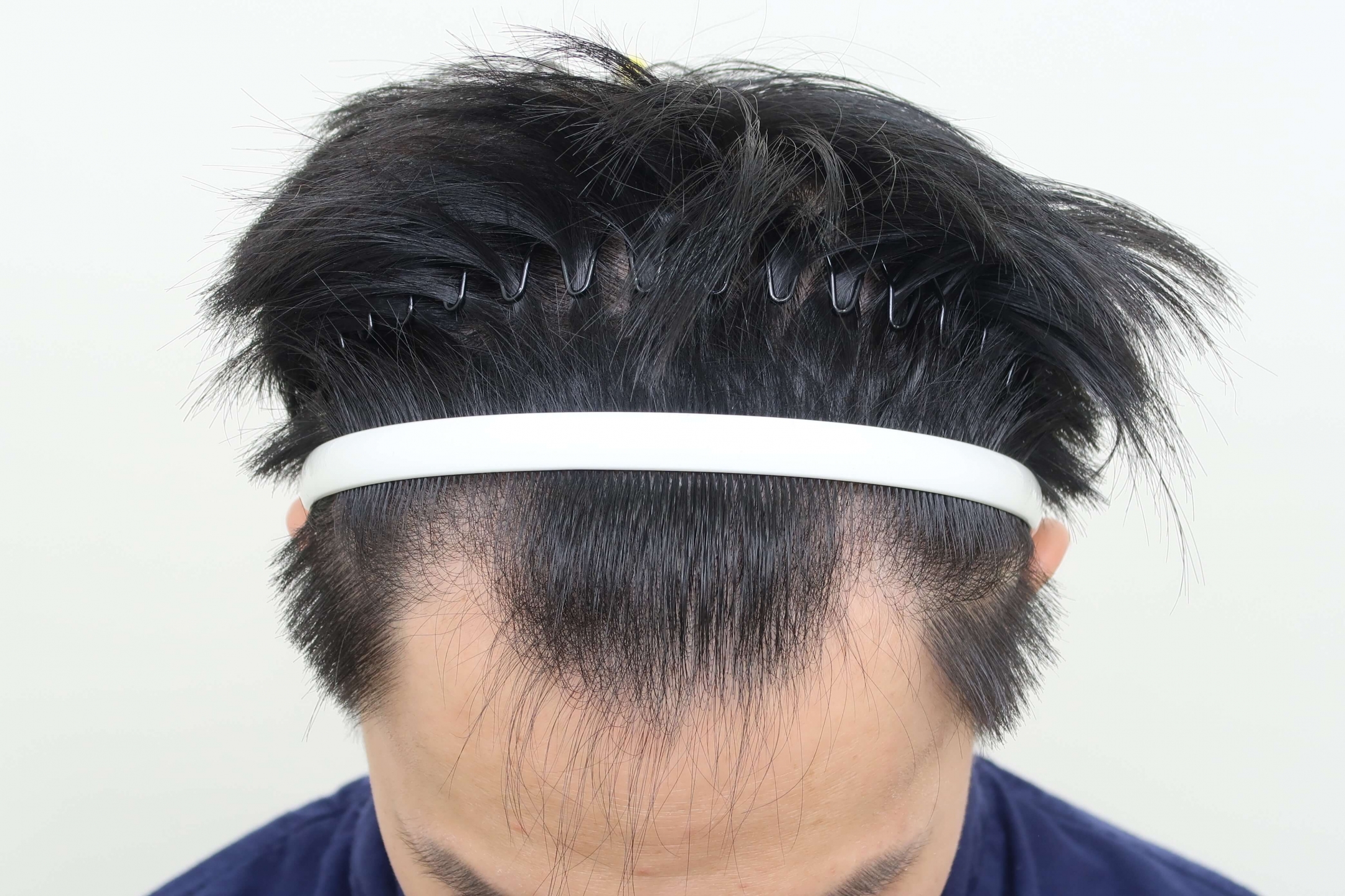 男性雄性禿初期徵兆：前額