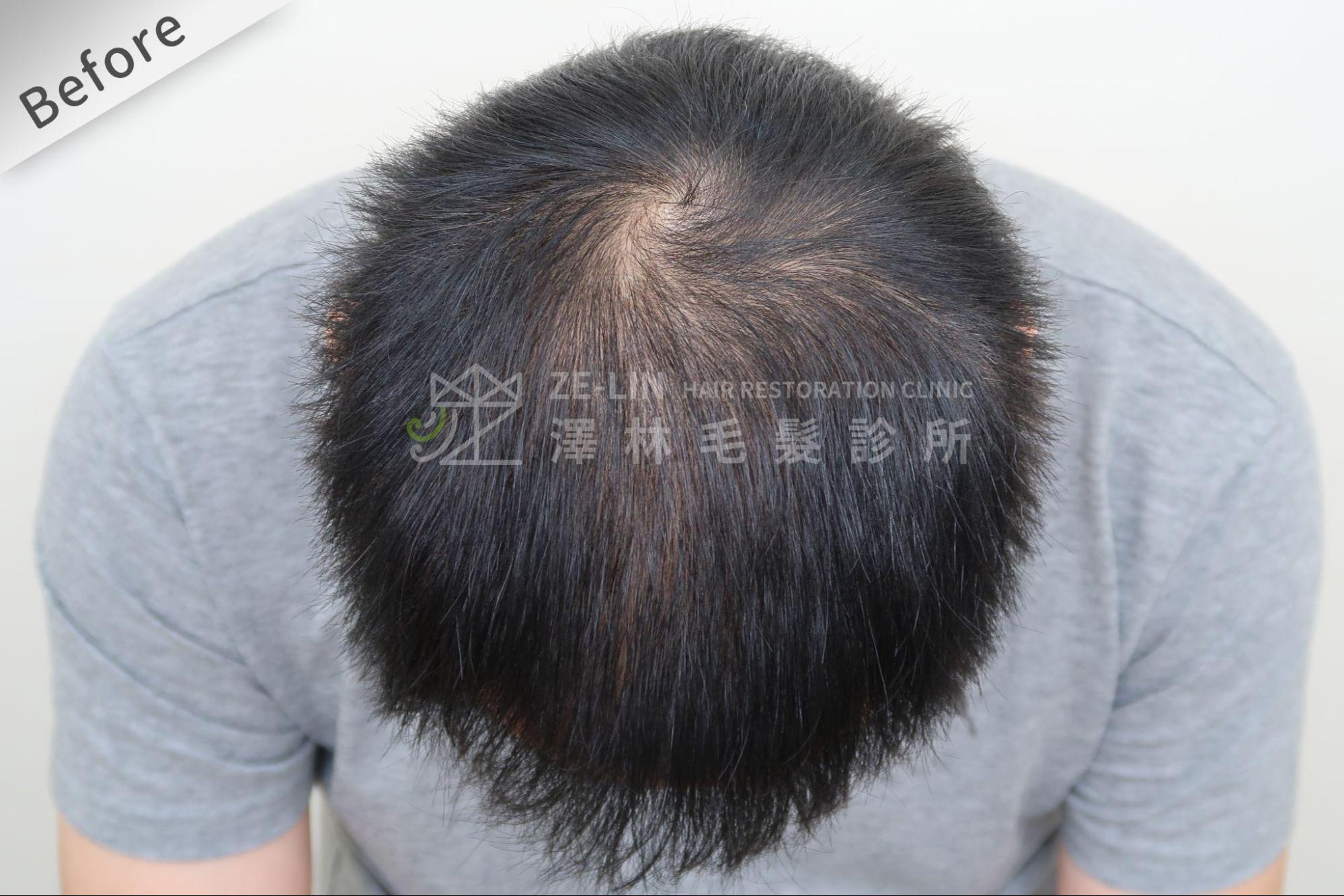 禿頭前兆可能為頭髮變細、變軟