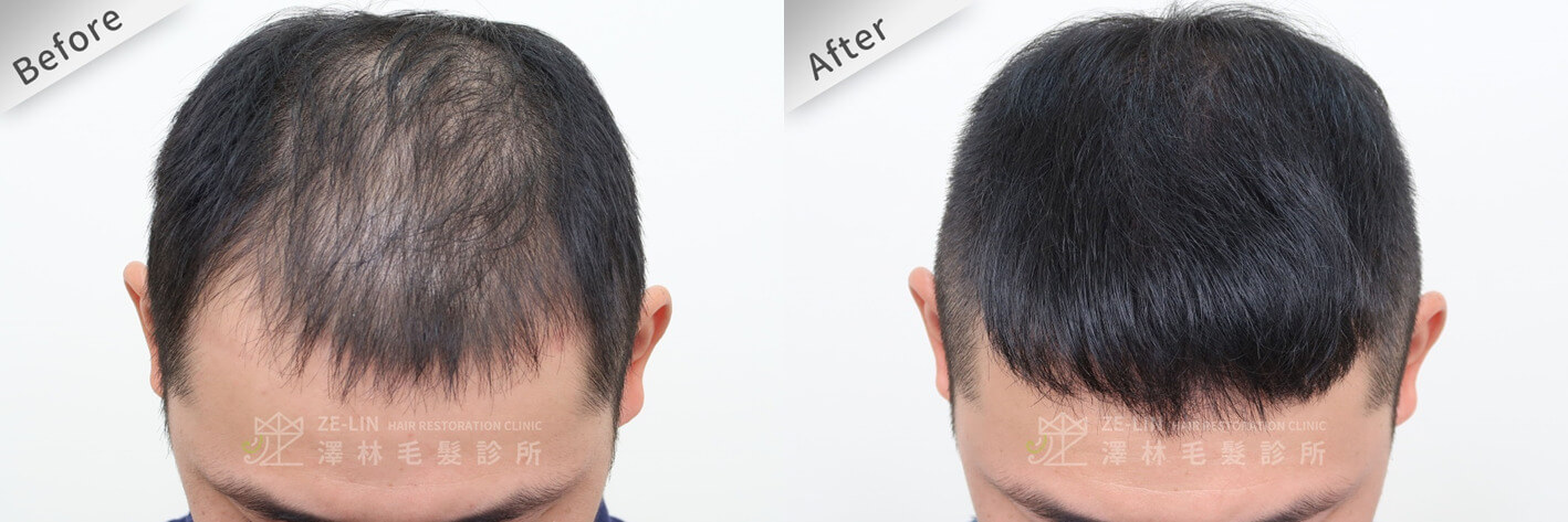雄性禿治療前後比對