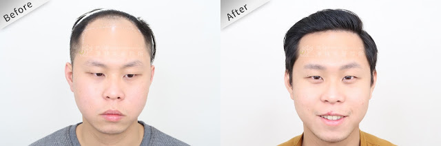 FUE植髮手術，重拾滿滿髮量與自信