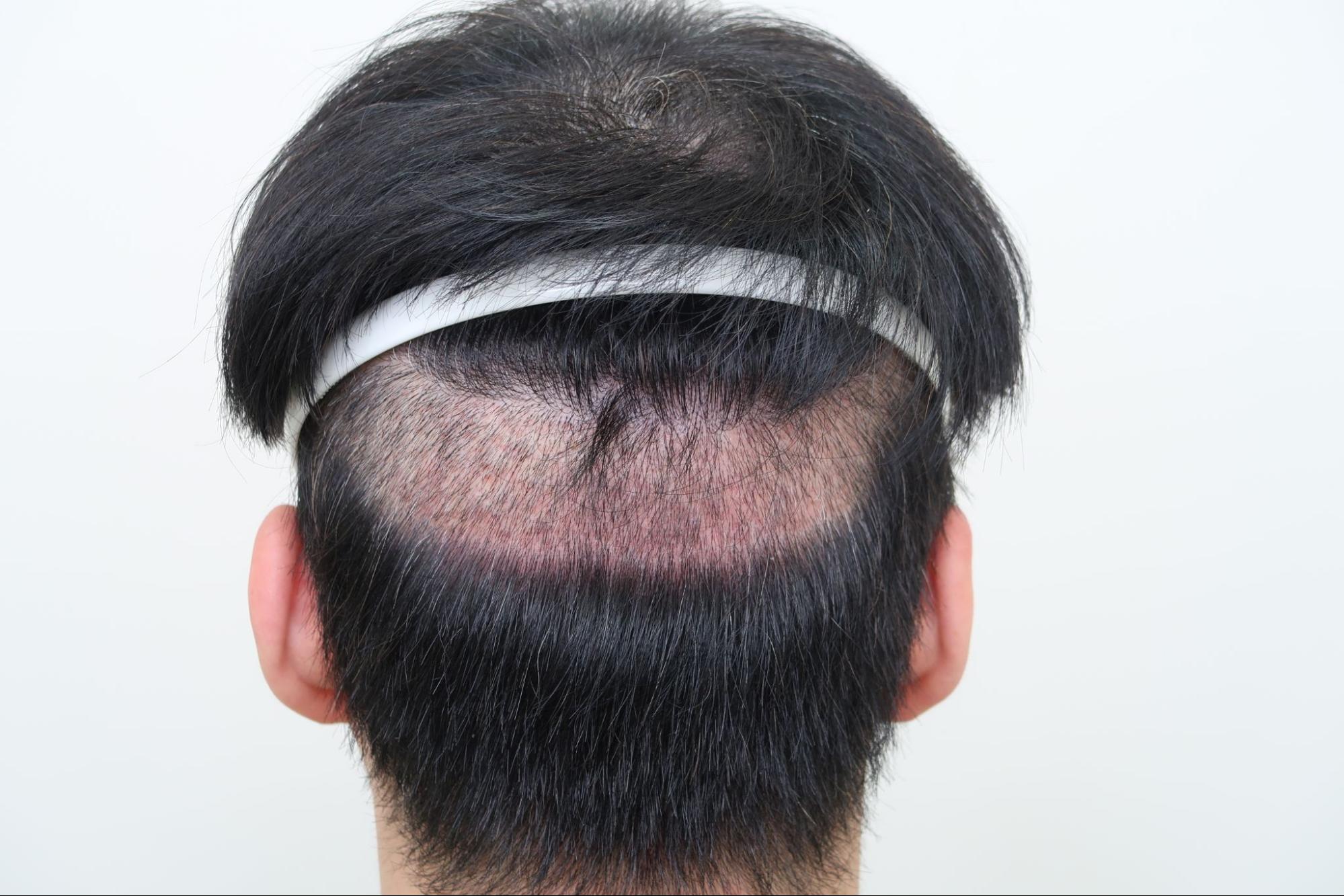 分層剃髮FUE遮蓋剃髮部位