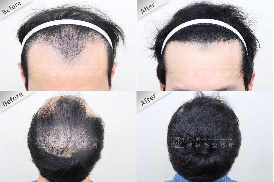 同一位髮友前額及頂部進行巨量植髮手術後的改變