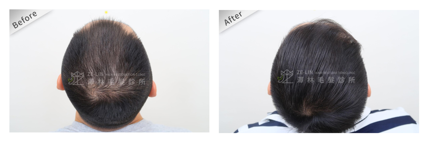 髮旋禿治療方法：自體育髮治療