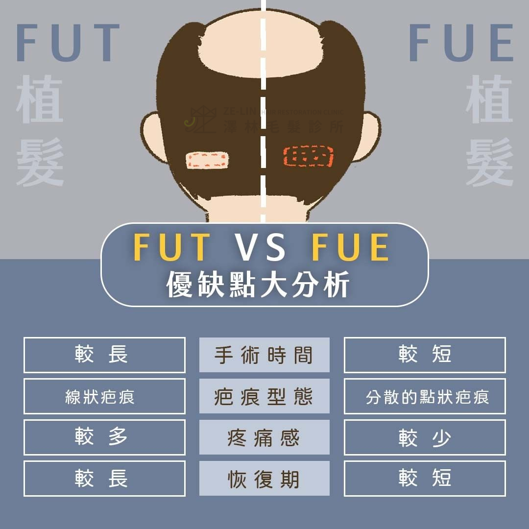 植髮懶人包：植髮手術前必備的10大基本概念- 專業毛髮衛教文章相關知識｜澤林毛髮診所ZE-LIＮ