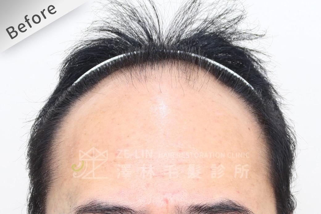 治療前患者有髮際線明顯後退的問題，由眉心到髮線的距離已達到公分