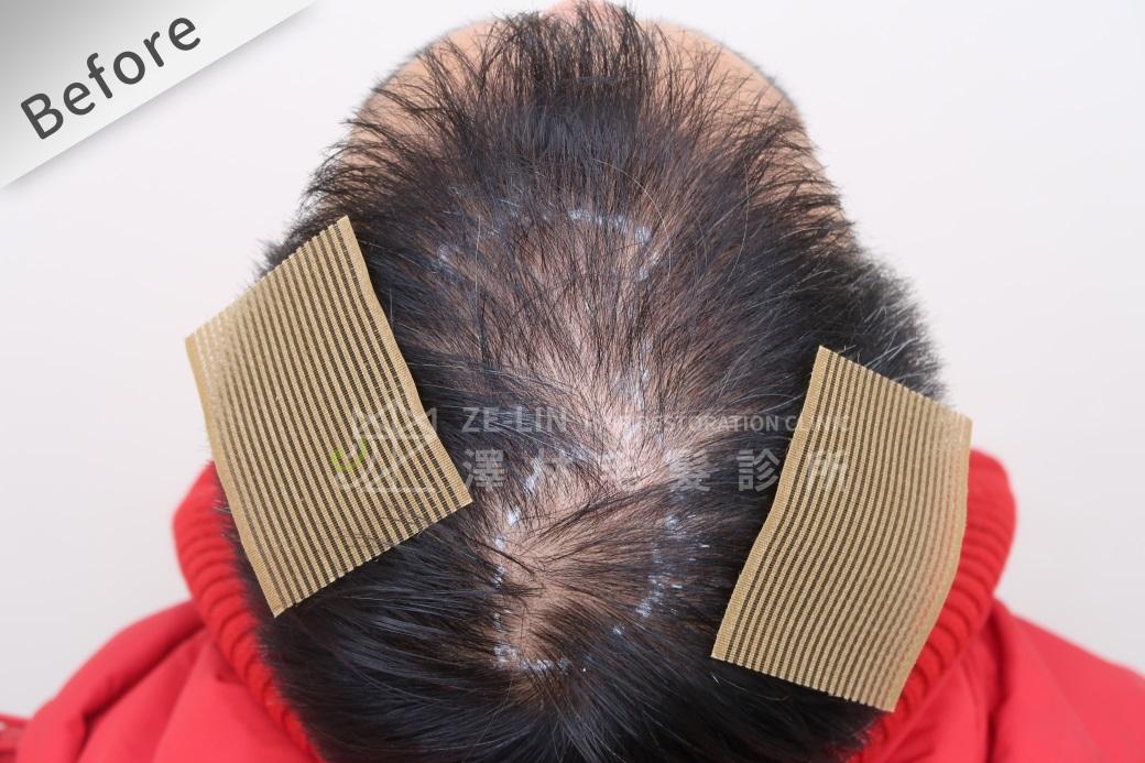 髮友治療前為第三期頂部雄性禿，整體頭頂的髮量稀疏且頭髮變細。  
