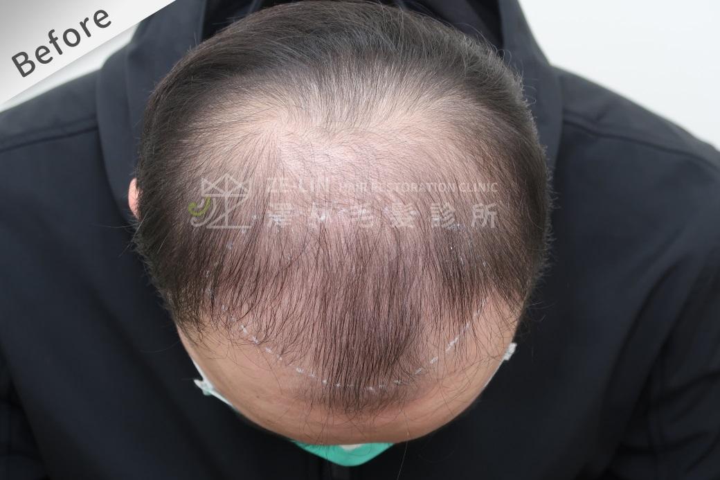 治療前患者為第五期雄性禿，從前額到頂部整體髮量都變得稀疏。