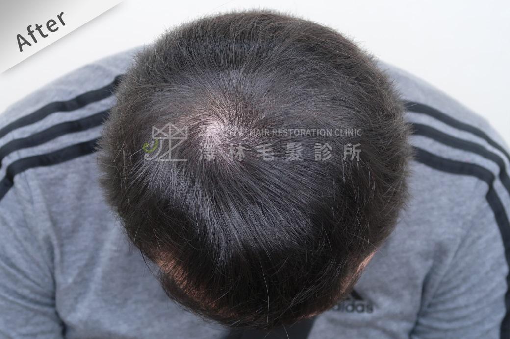 術後效果：手術後一年觀察，整體髮量幾乎回復到未落髮前的樣貌。
