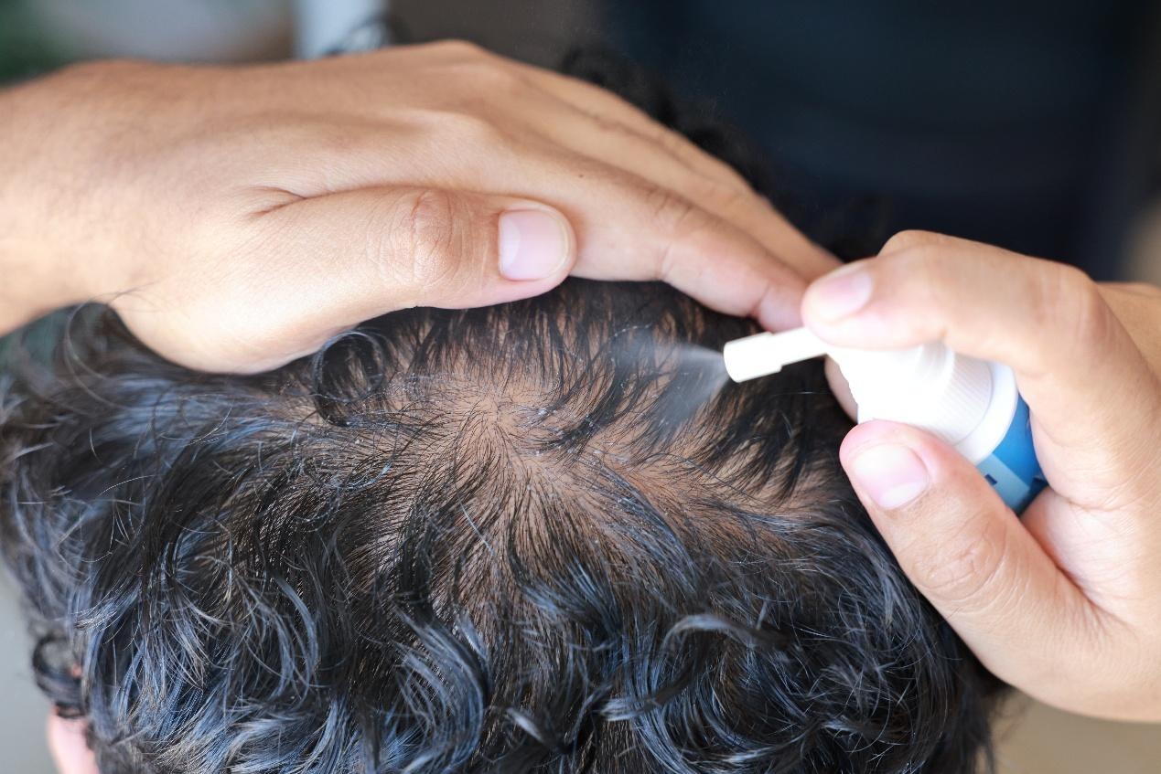 高額頭女孩髮際線設計