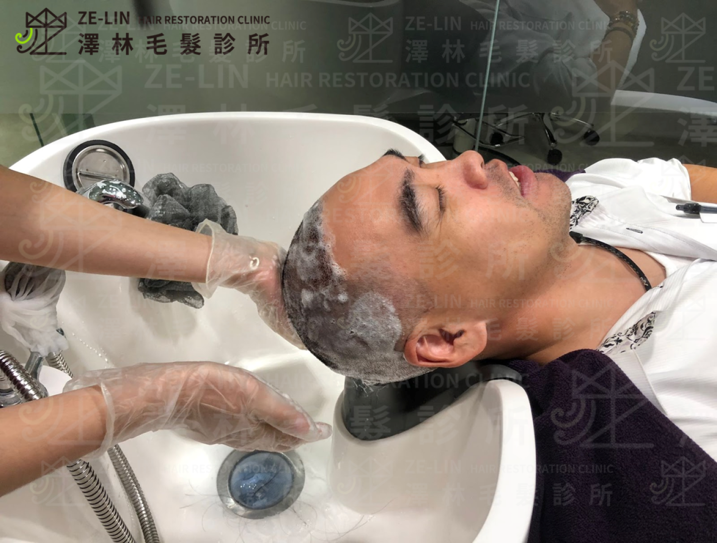 M型禿植髮手術後,回診洗頭護理
