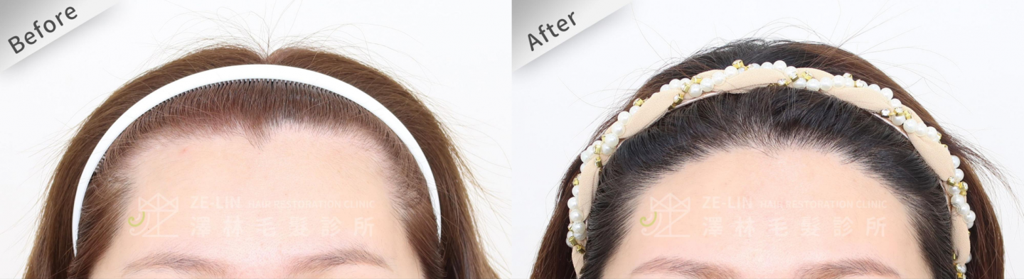 女性免剃髮FUE植髮