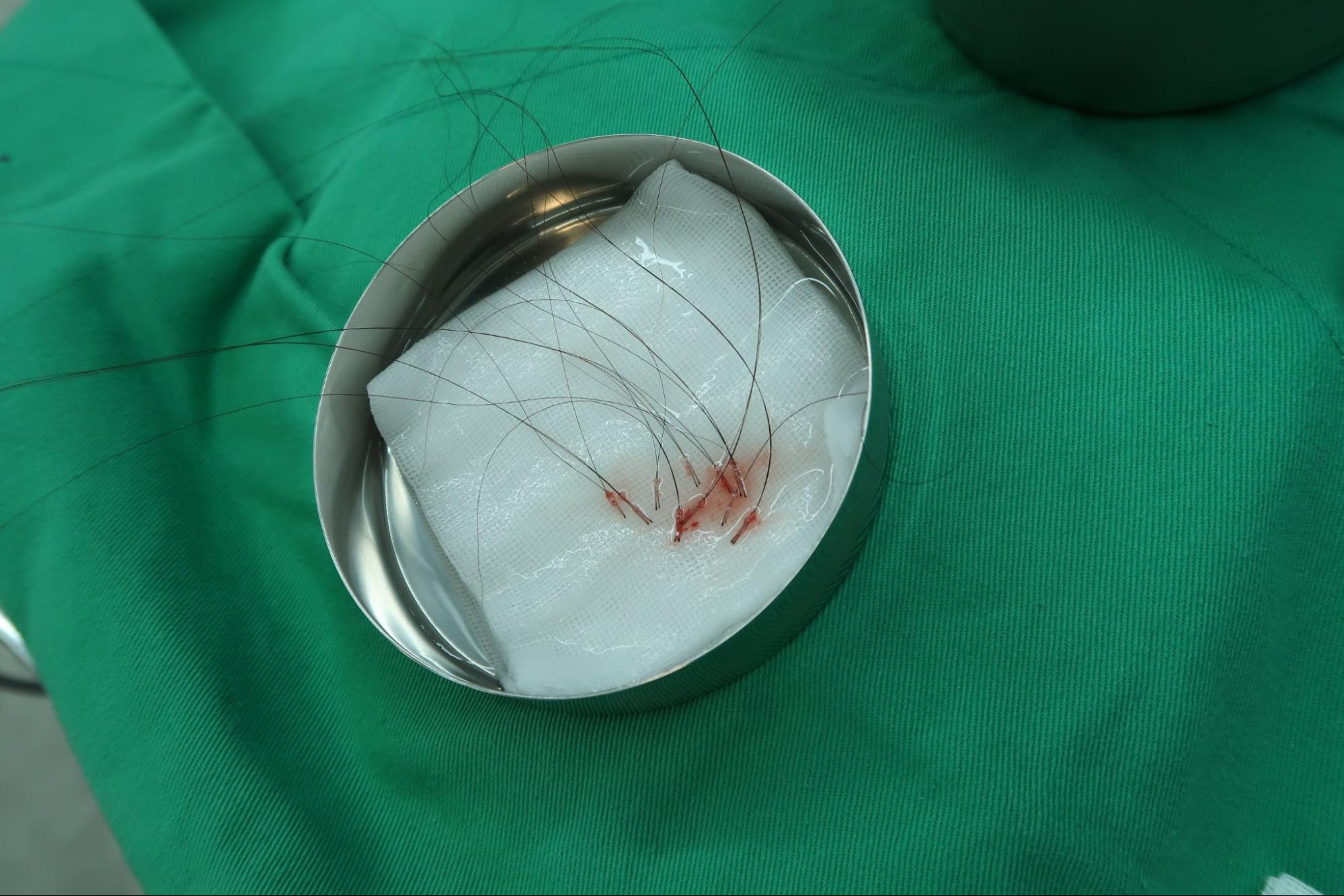 澤林免剃髮FUE取下長頭髮毛囊