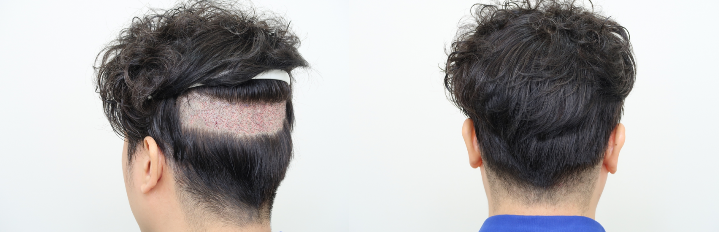 除了免剃髮FUE，可考慮分層剃髮