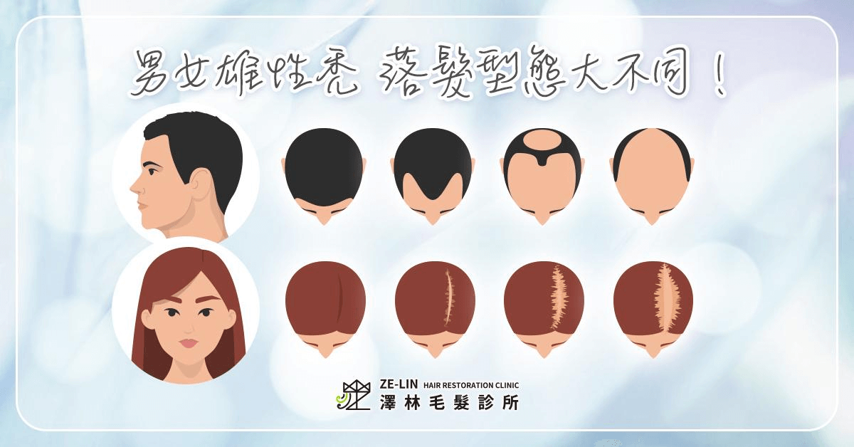 男性、女性雄性禿落髮型態​​比較圖